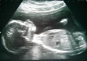 Scan of 20 week old baby.