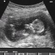 Scan of baby in womb, abortion, pro life